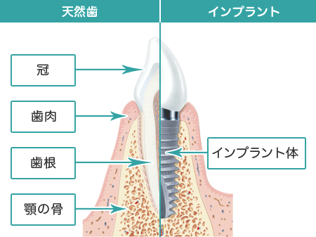 インプラント画像